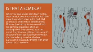 is that a sciatica