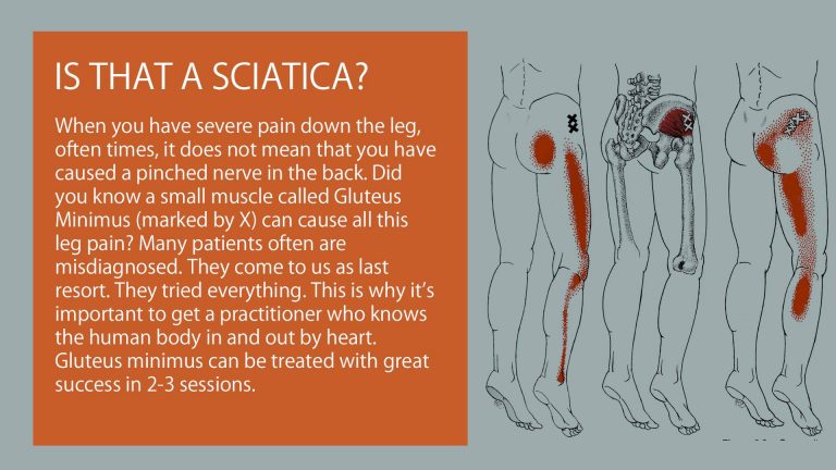 Blog 1 is that a sciatica