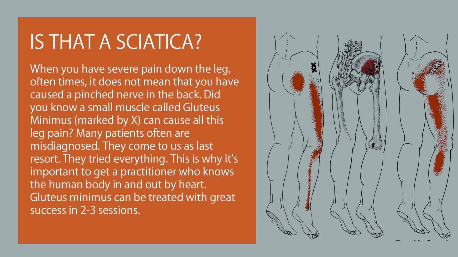 is-that-a-sciatica