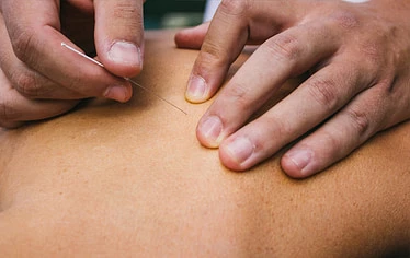 Acupuncture 9 Client Receiving Acupuncture Services in Ottawa- (2)