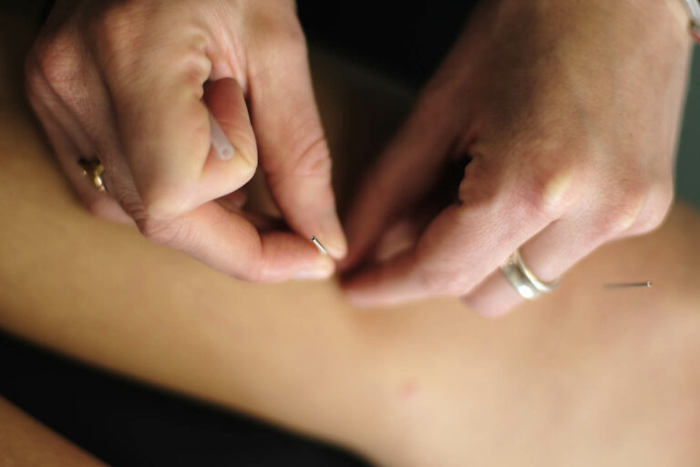 medical acupuncture ottawa