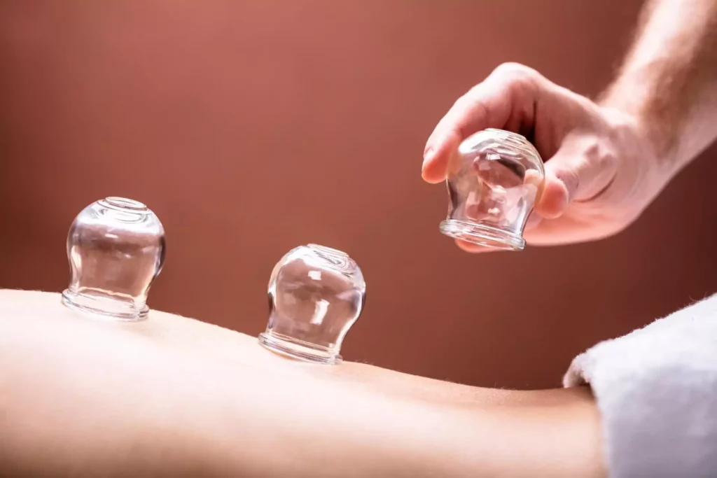 What is Cupping Treatment