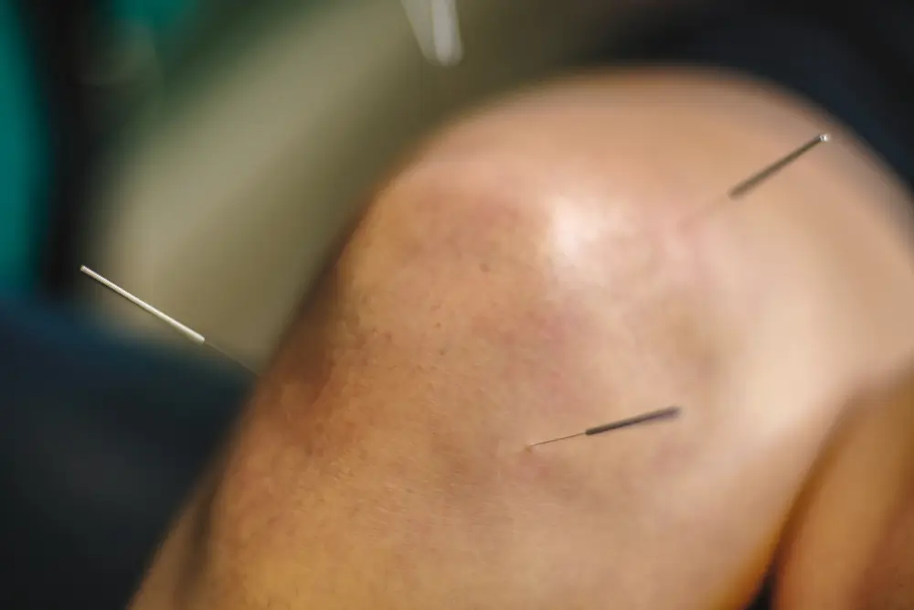 Medical acupuncture treatments in Ottawa