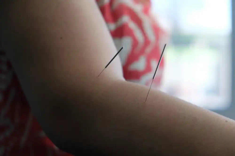 Acupuncture ottawa treatment