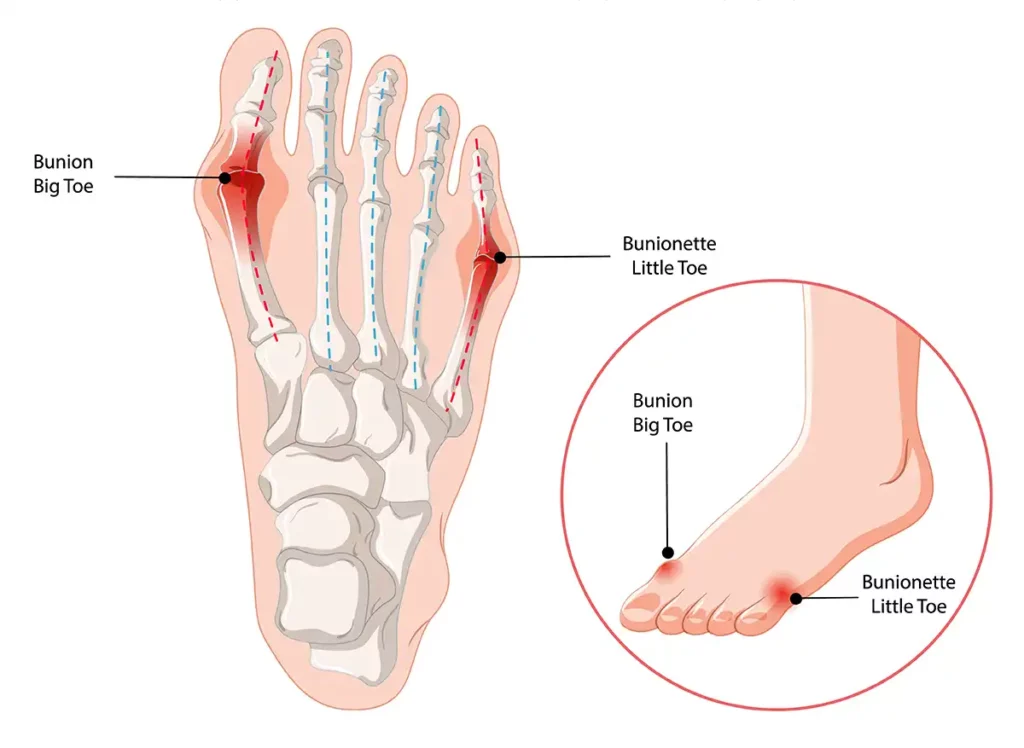 Bunions