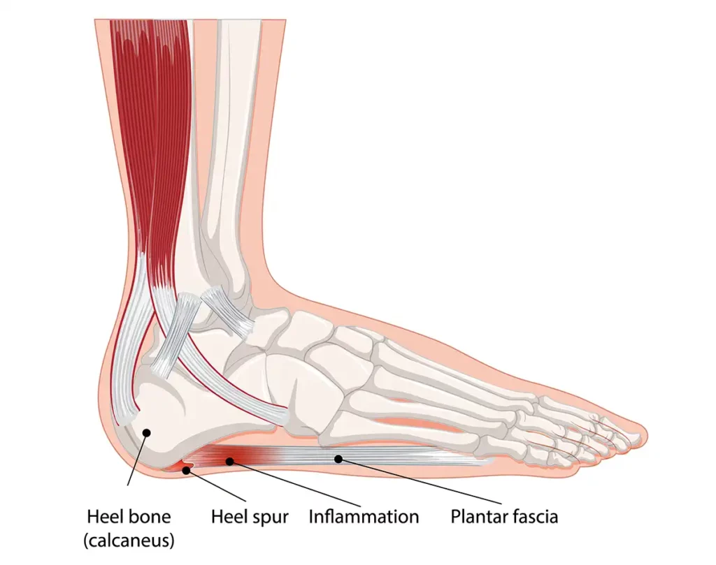 Plantar Fasciitis heel pain