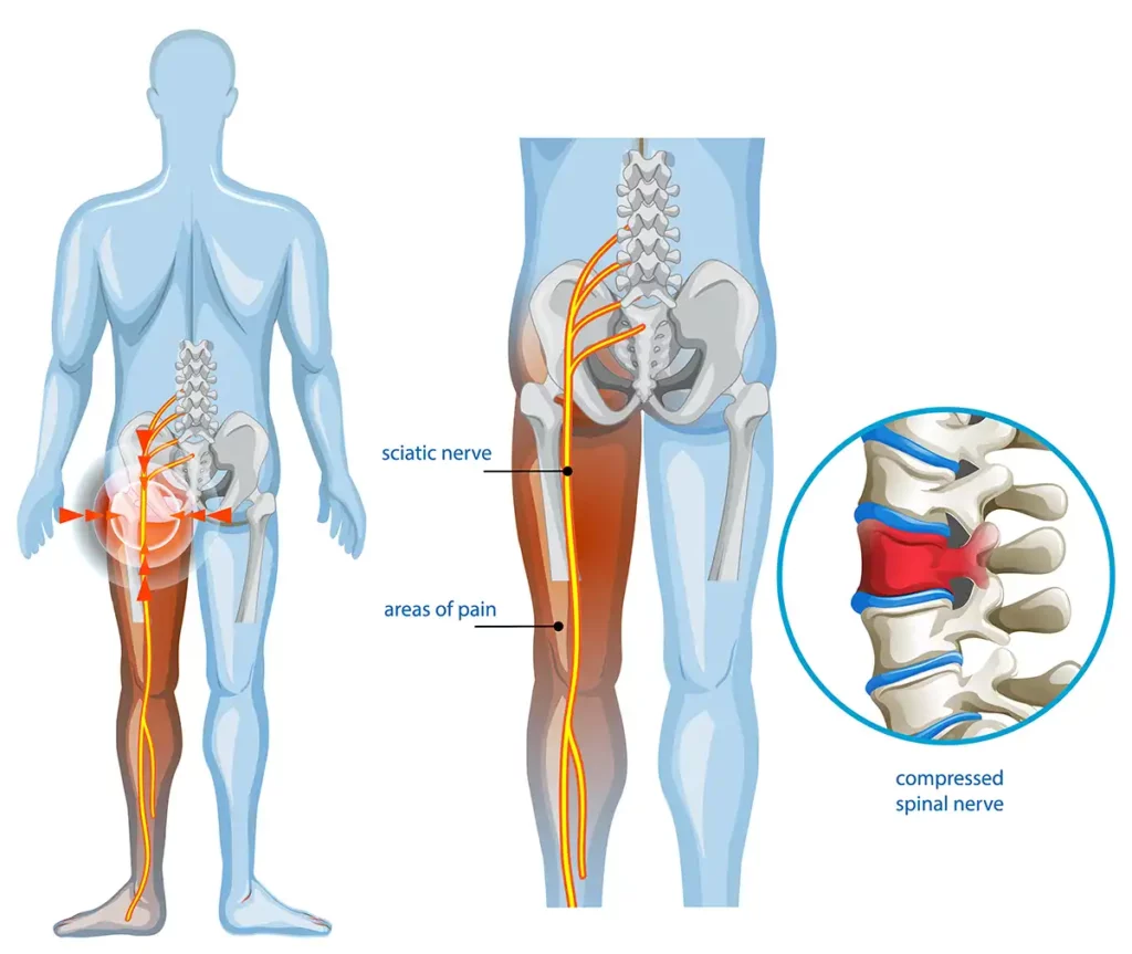 Sciatica