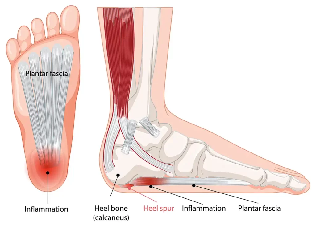 What is Heel Spur