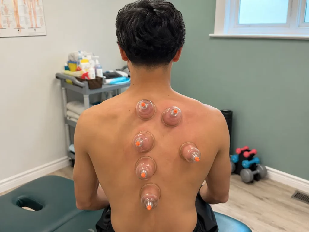 Cupping therapy session in clinic